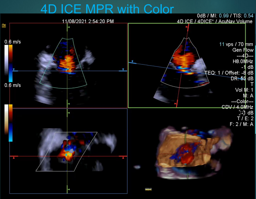 術(shù)中超聲成像新技術(shù)|心腔內(nèi)超聲（ICE）②市場(chǎng)研發(fā)篇